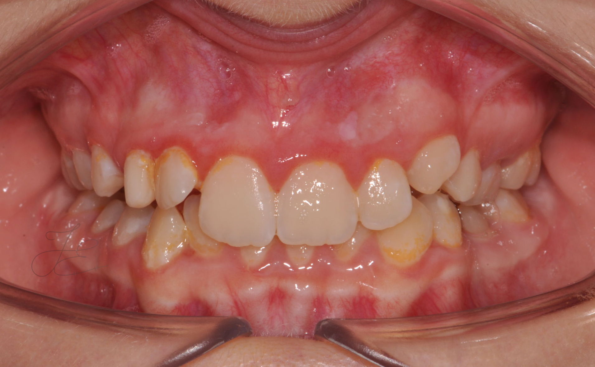 Caso clinico dopo la ortodontica