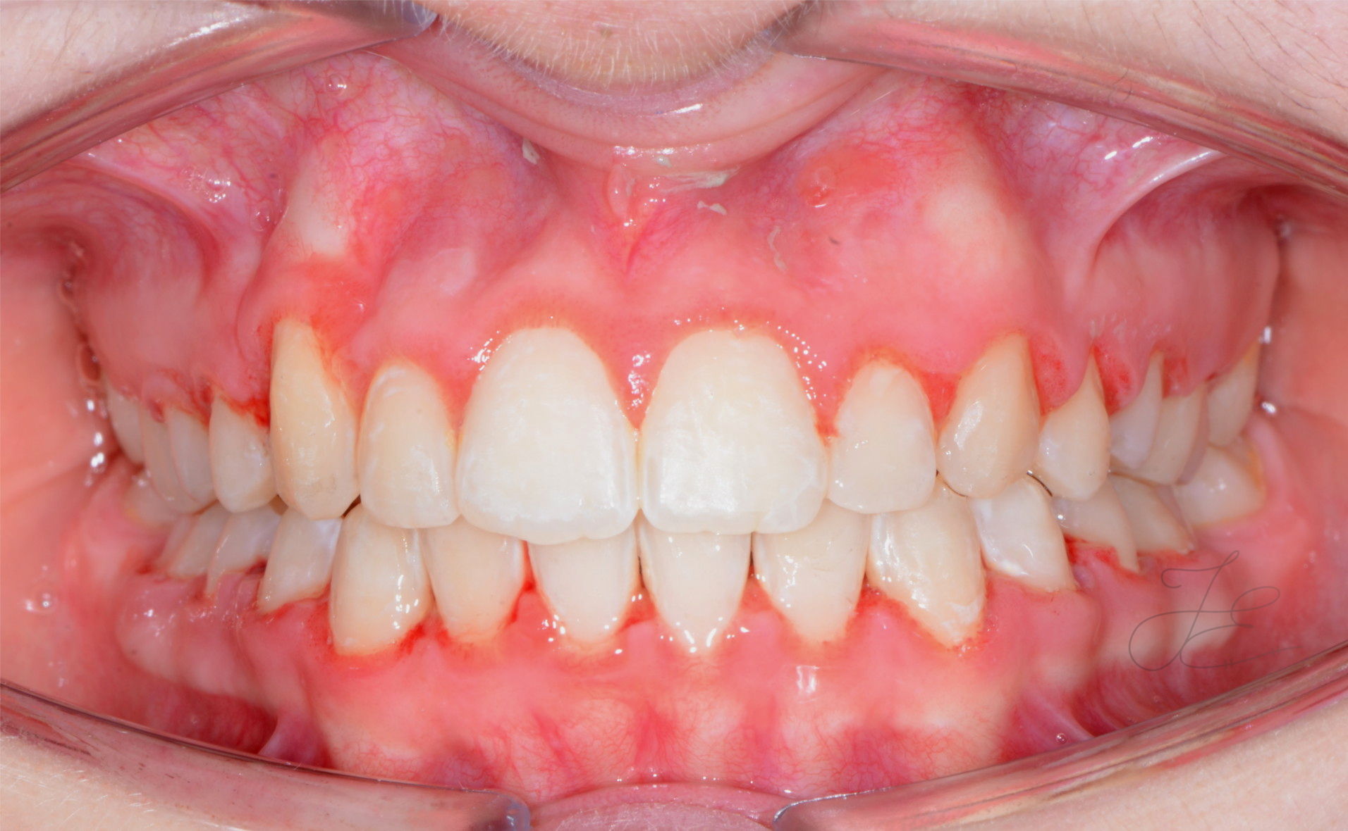 Caso clinico prima della terapia ortodontica